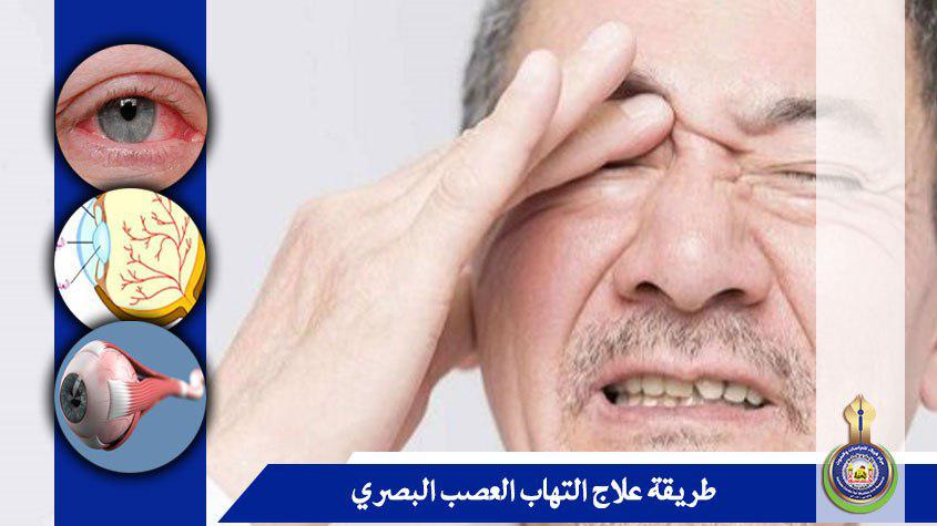 طريقة علاج التهاب العصب البصري
